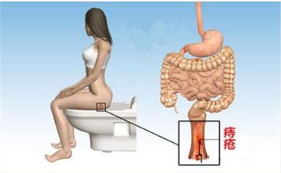 孕婦痔瘡如何護理？